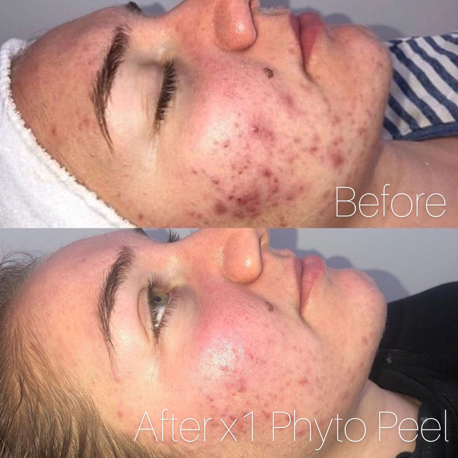 Side-by-side facial acne comparison labeled “Before” and “After x1 Phyto Peel.”