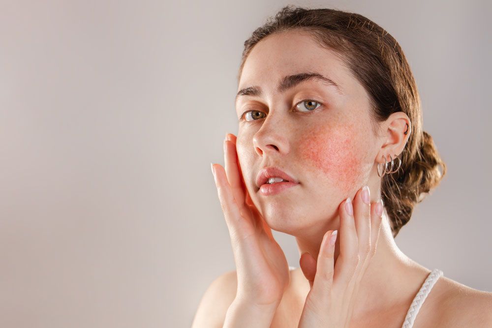 Woman applying skincare cream to her face, with a red, irritated cheek.