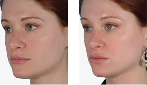 Obagi Nu-Derm System - Alamo, CA - Alamo MD Med Spa Side-by-side comparison: woman's face before and after cosmetic treatment. Skin appears smoother, brighter after treatment.