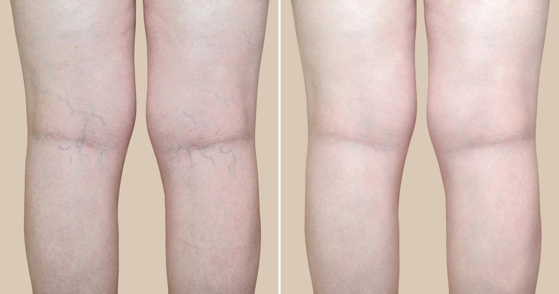 Legs, pre- and post-hair removal. Before image shows visible hair on legs. After image shows smooth legs.