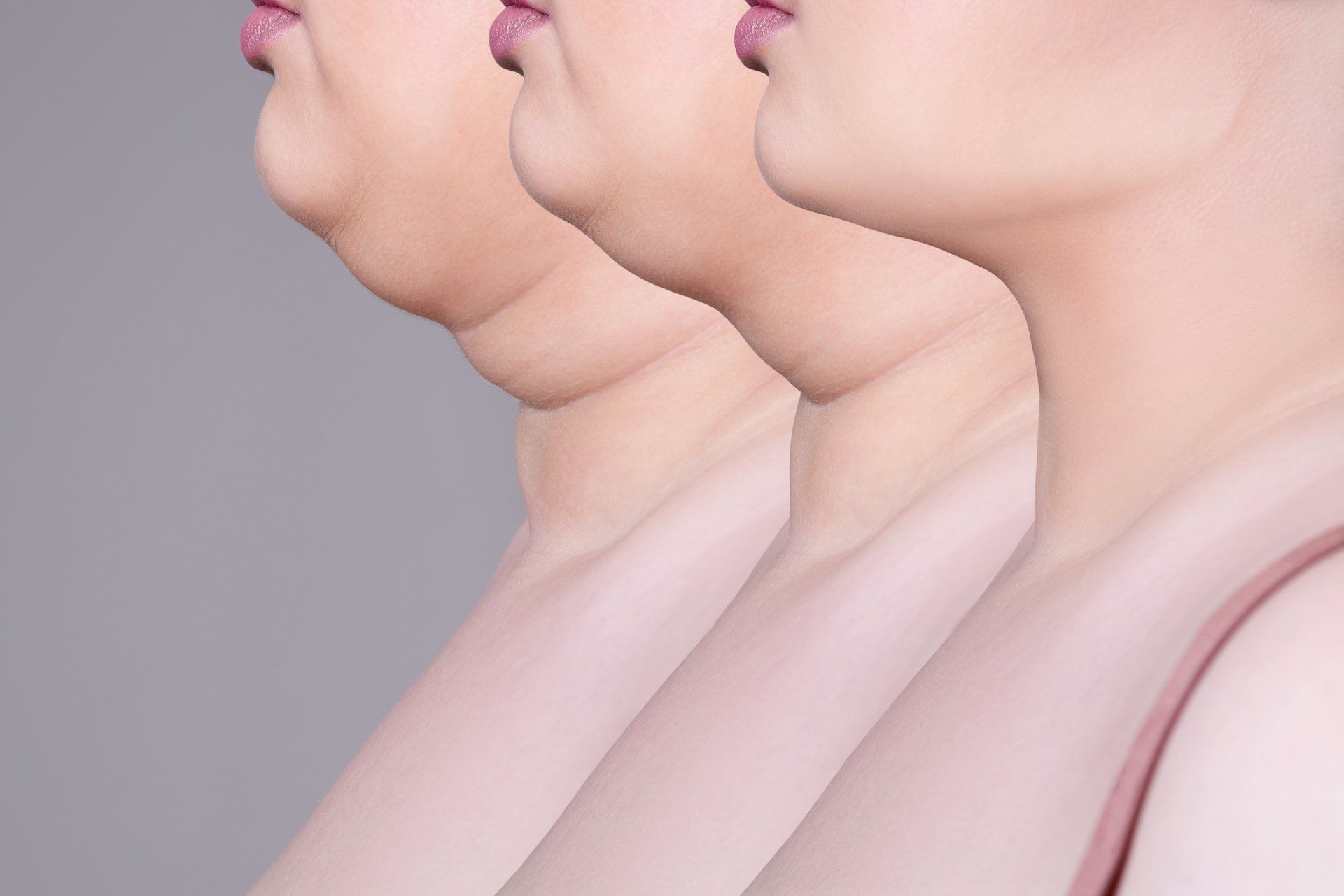 Double chin reduction stages Progression of double chin reduction, showing neck profiles from full to improved appearance.