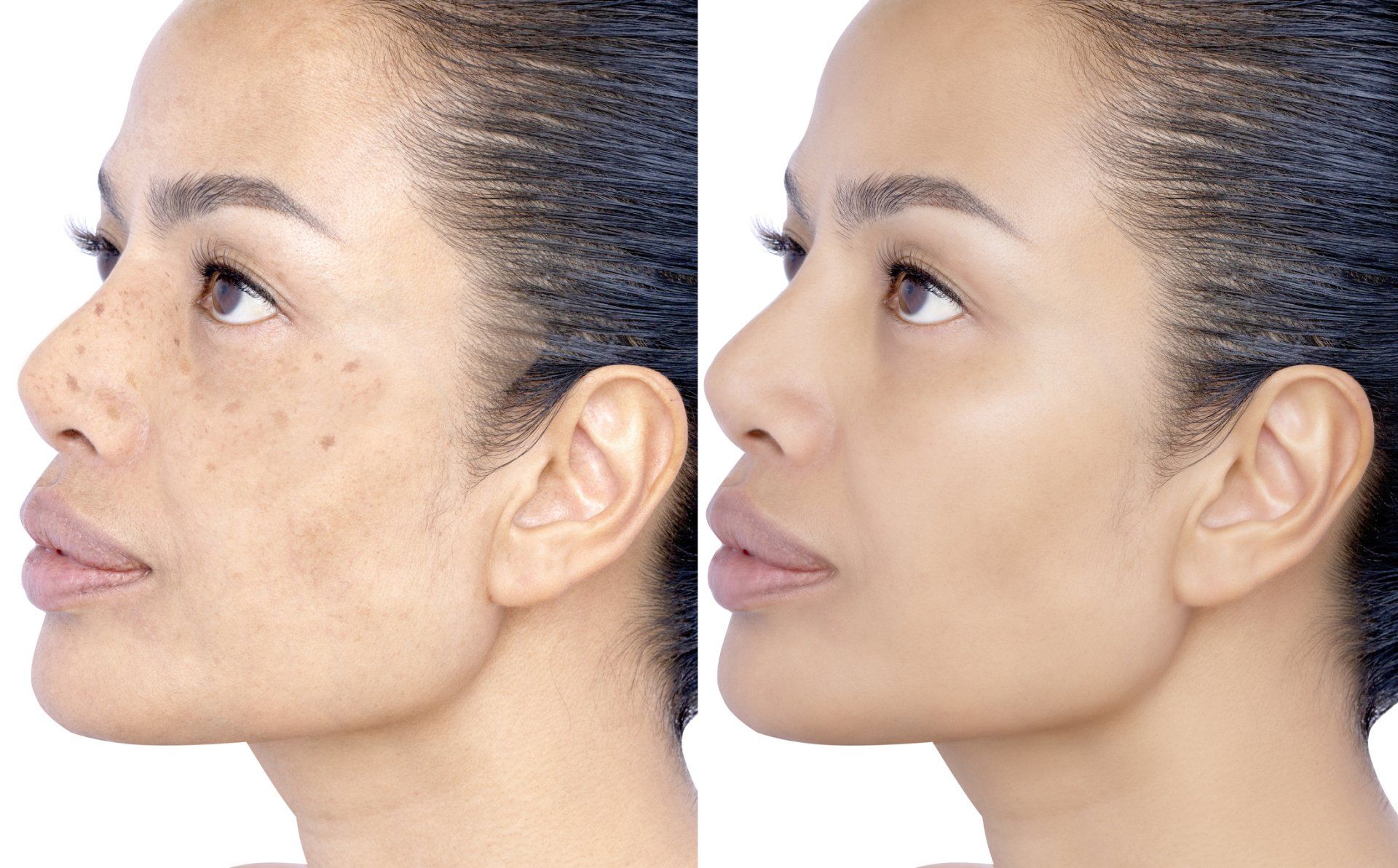 Side-by-side comparison of a woman's face. Left side shows skin discoloration. Right side shows even skin tone.