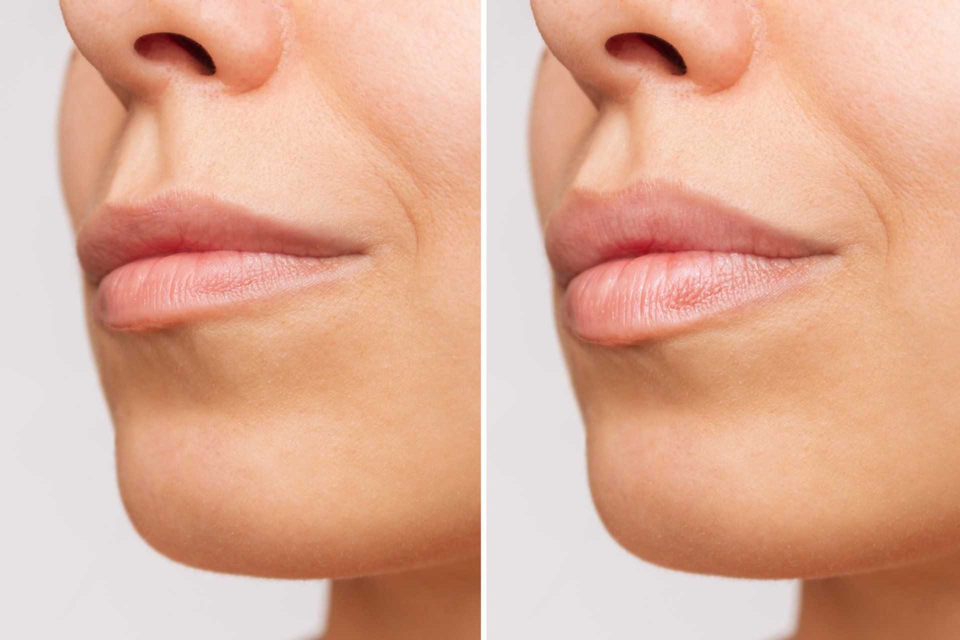 Side-by-side comparison of a person's lower face. Left shows wrinkles around the mouth. Right shows smoother skin after a procedure.