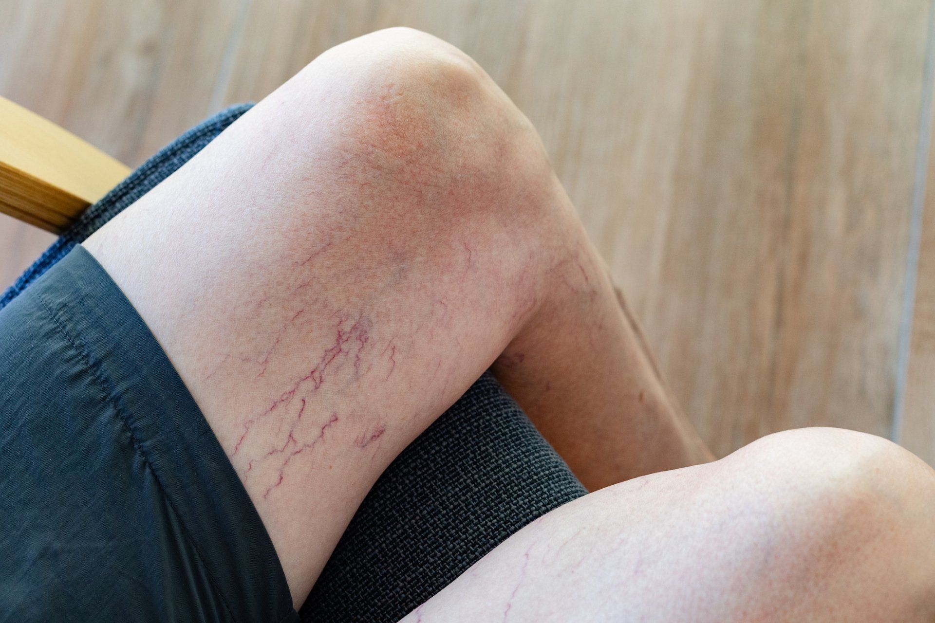Leg with visible spider veins, appearing on the inner thigh and knee area.
