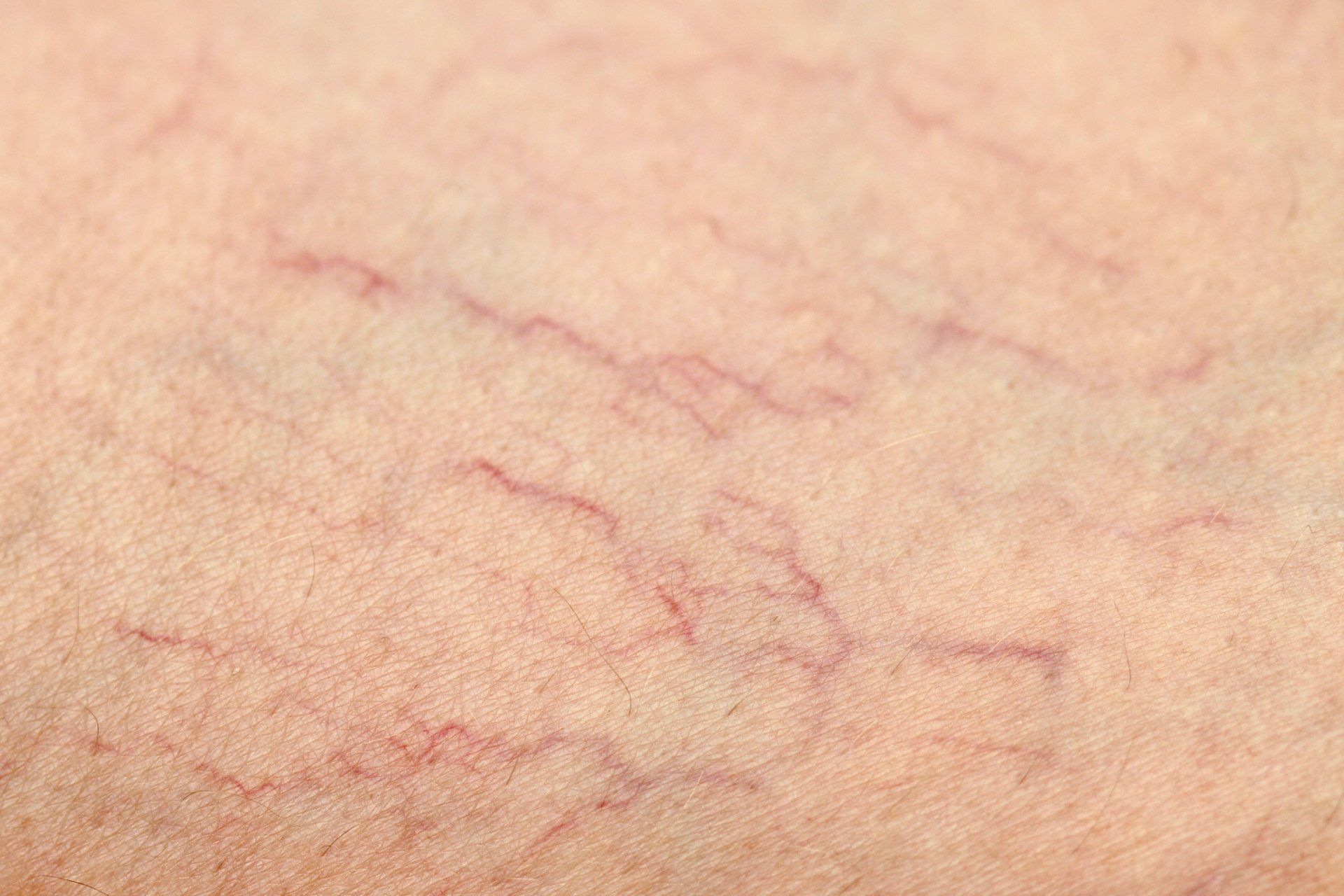 Close-up view of skin with visible, fine red spider veins.