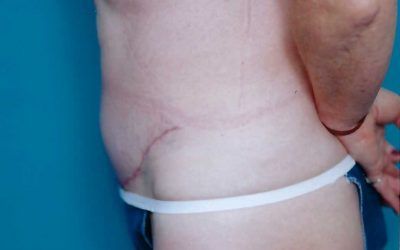 after of a male abdominoplasty