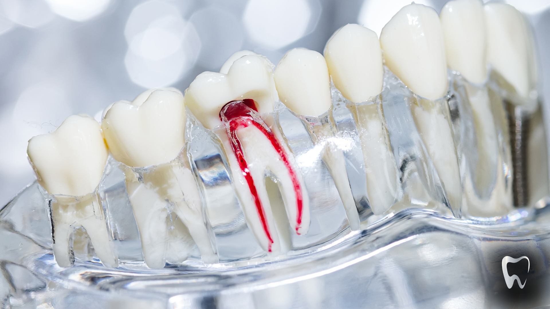 Dental model showing a tooth with exposed, red pulp; other white teeth are in clear plastic.