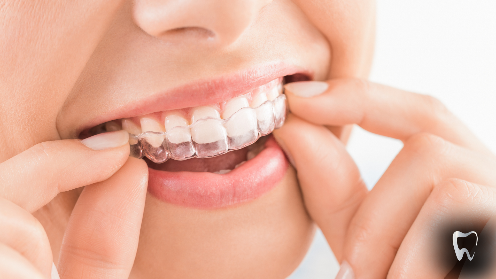 Person inserting clear orthodontic aligner into their mouth.
