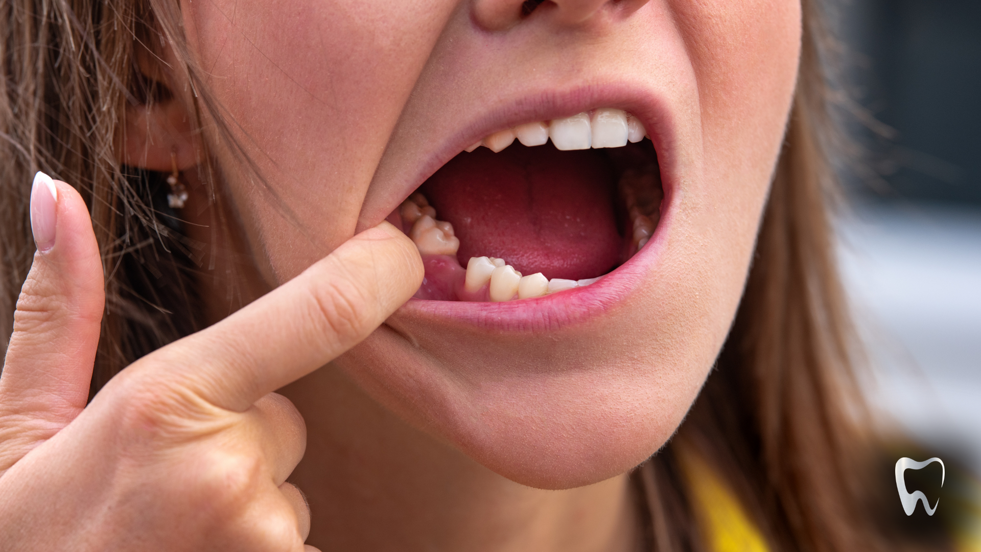 Woman pointing at a missing tooth in her mouth, open wide with an anxious expression.