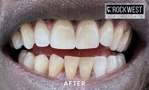 A close up of a person 's teeth after a dental treatment.