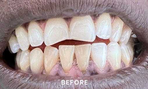 A close up of a person 's teeth before whitening.