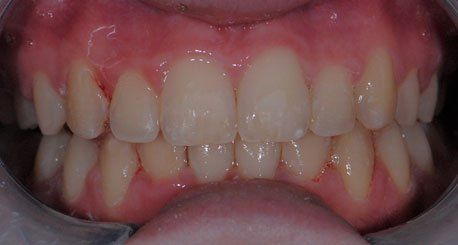 Orthodontics after braces
