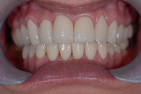 Teeth After Crowns