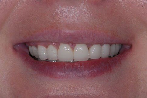 Teeth After Crowns