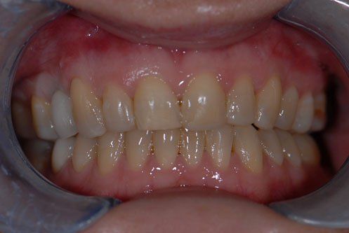 Teeth Before Crowns