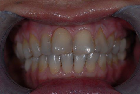Teeth Before Crowns
