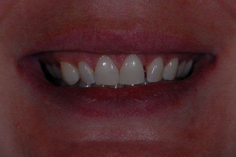 Teeth Before Crowns