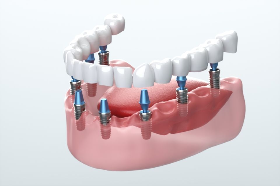 impianti dentali