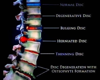 Diagram of a spine illustrating different stages of disc problems, labeled with the type of disc issue.