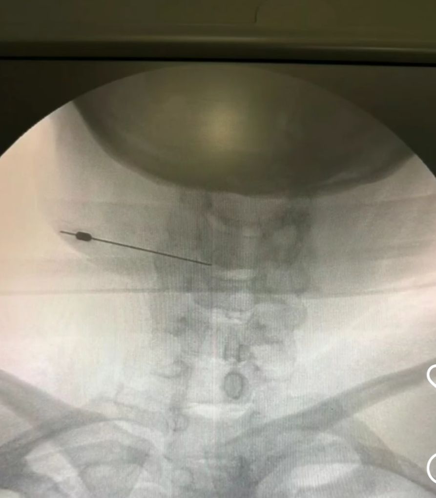 Cervicalgia dolor de cuello