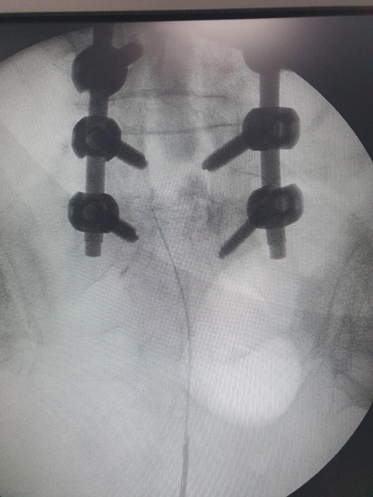 Dolor Crónico Postquirúrgico