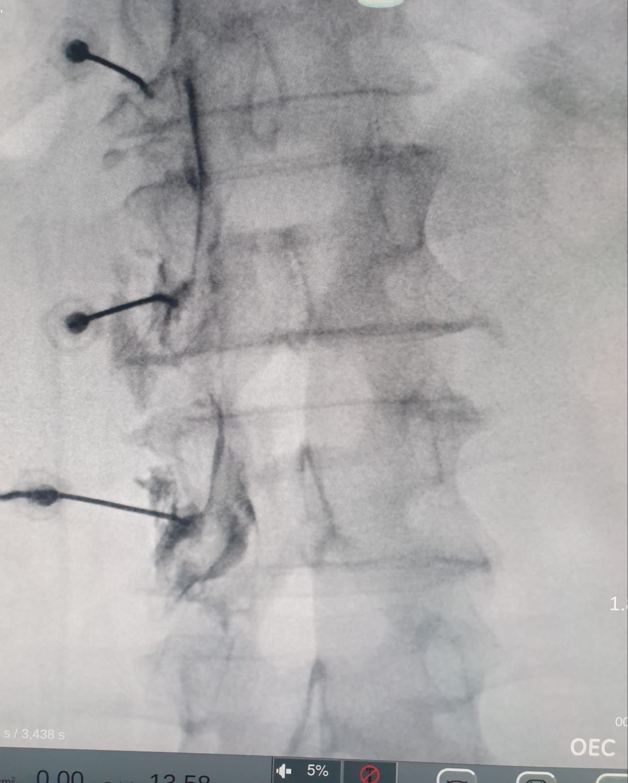 Lumbalgia