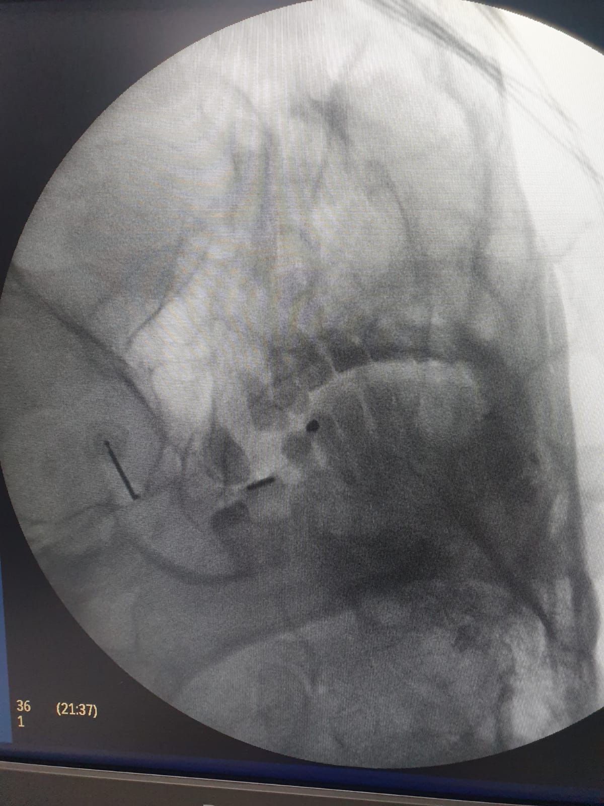 Neuralgia del trigémino
