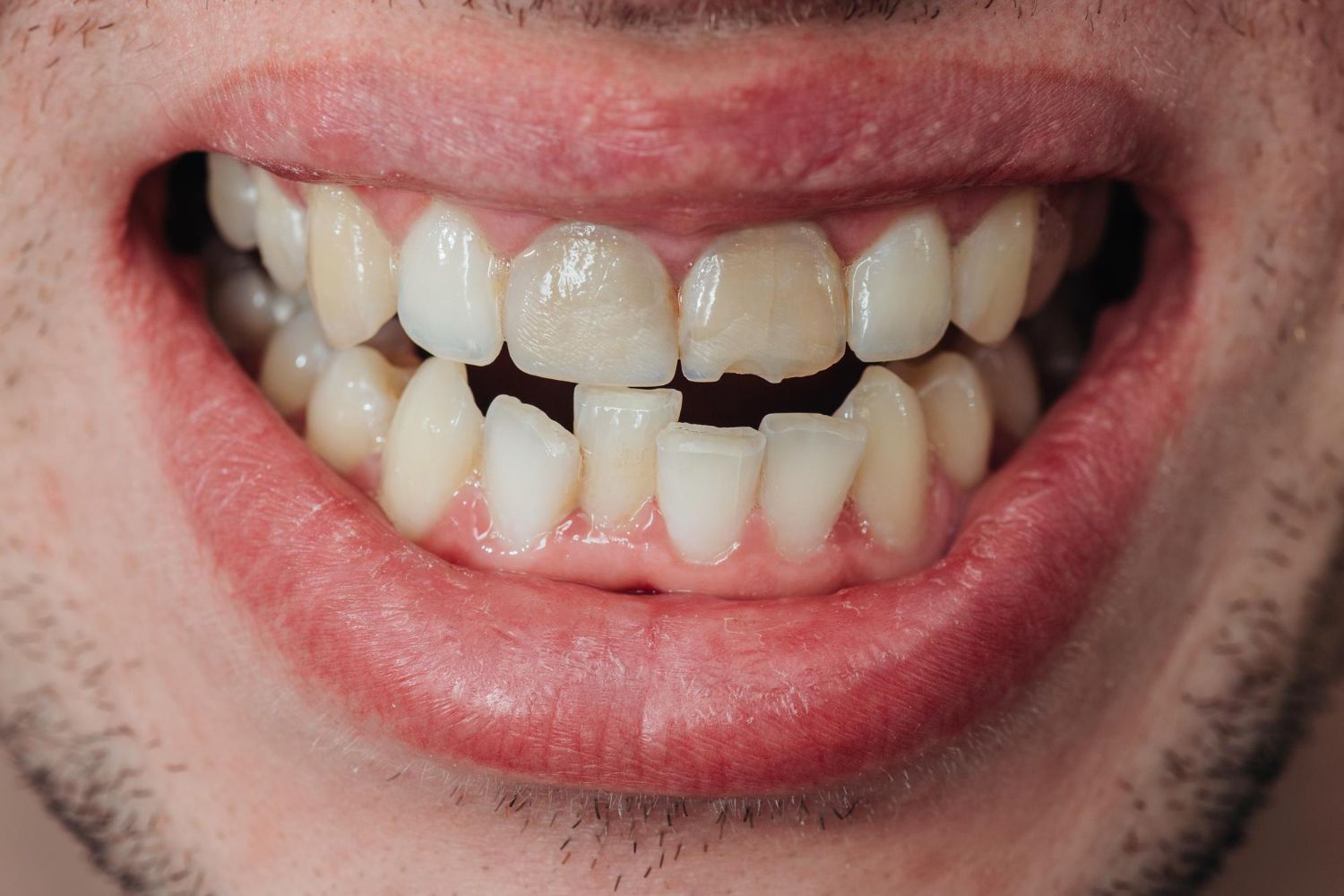 how to fix crooked teeth