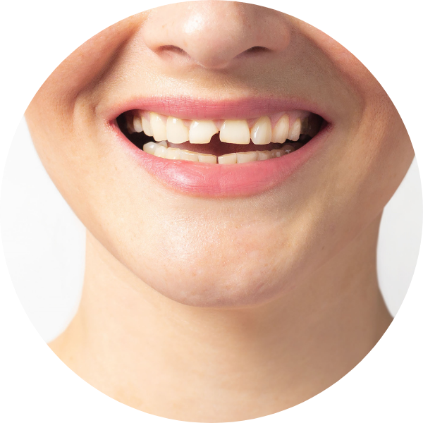crooked teeth