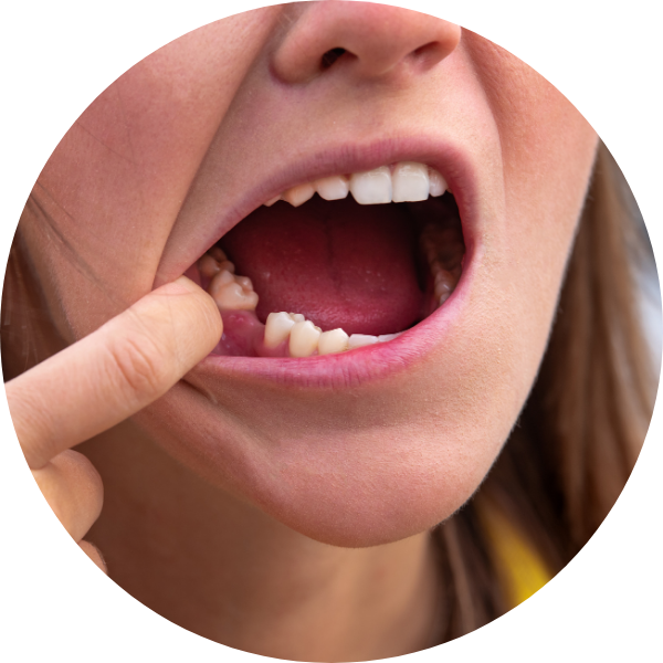 missing teeth