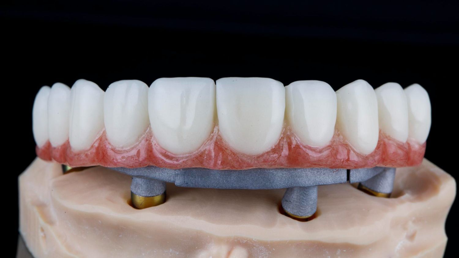 dental-bridge-types-nyc