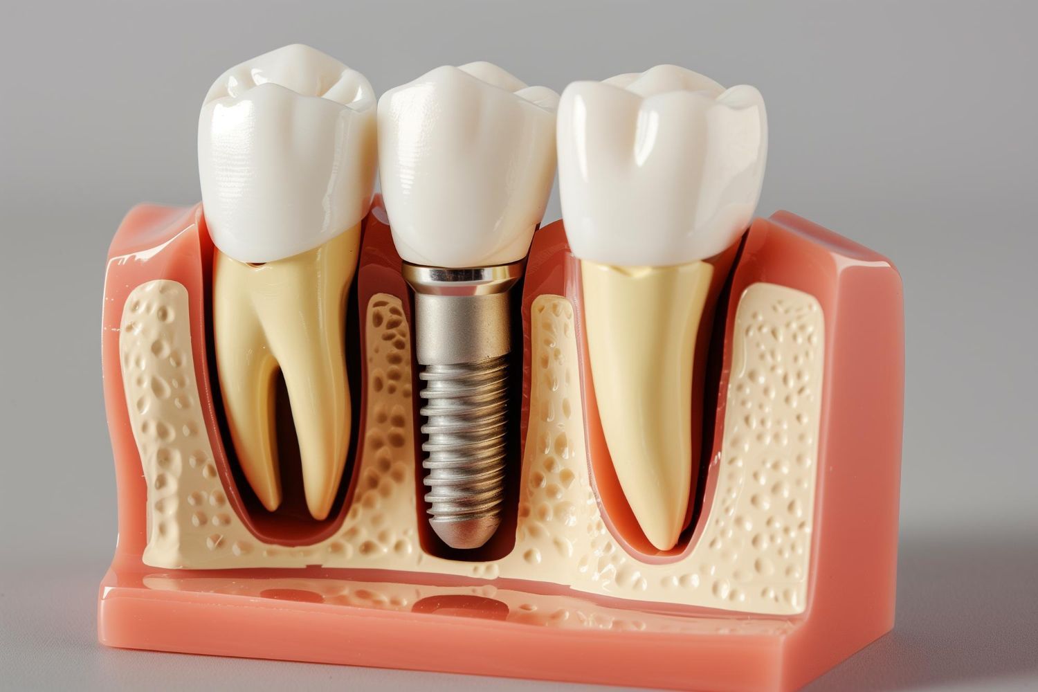 Dental Bridge vs Implant for One Missing Tooth