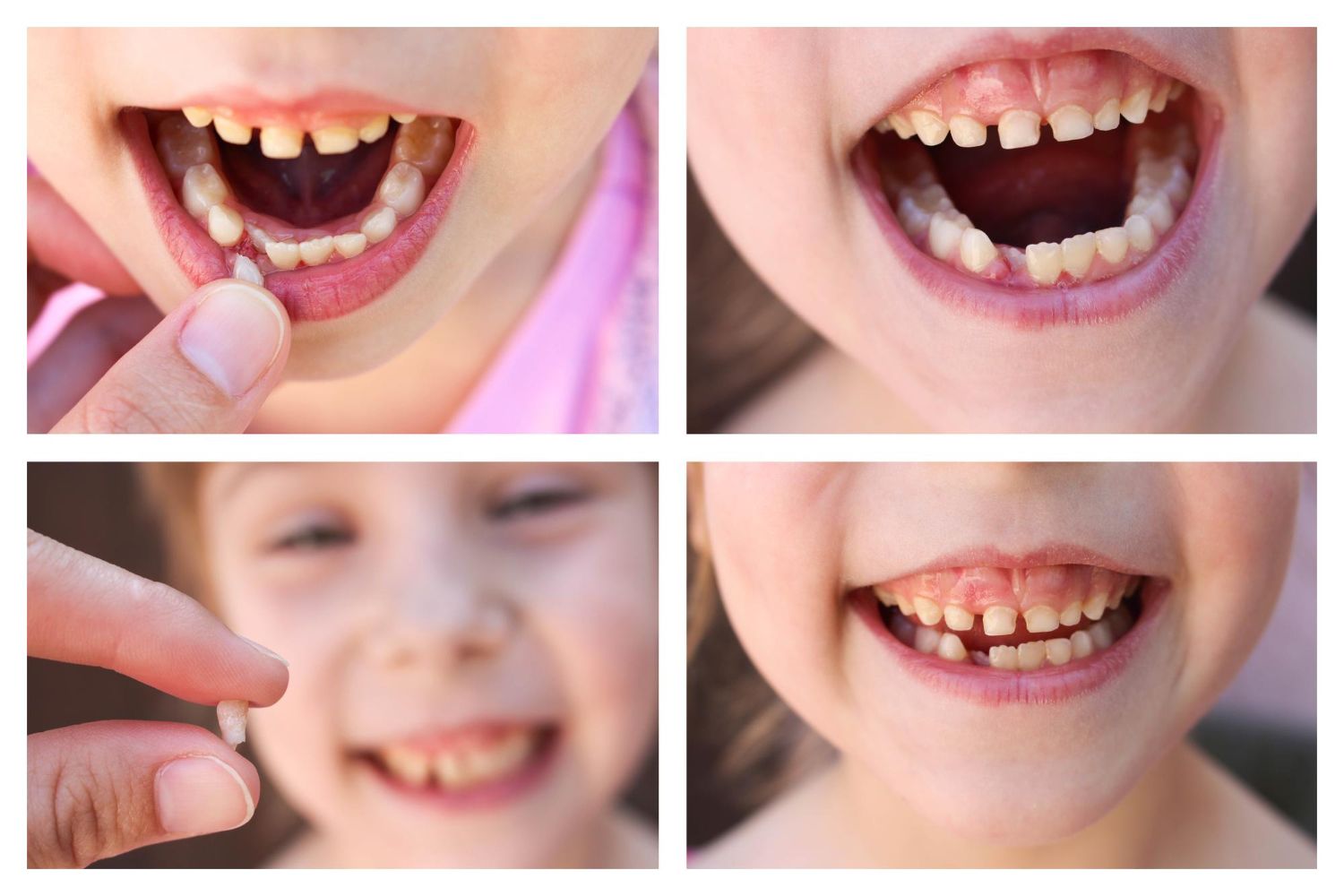 types-of-crooked-teeth