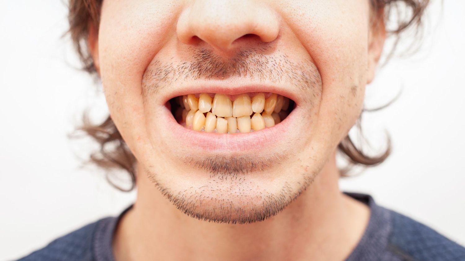 causes yellow teeth