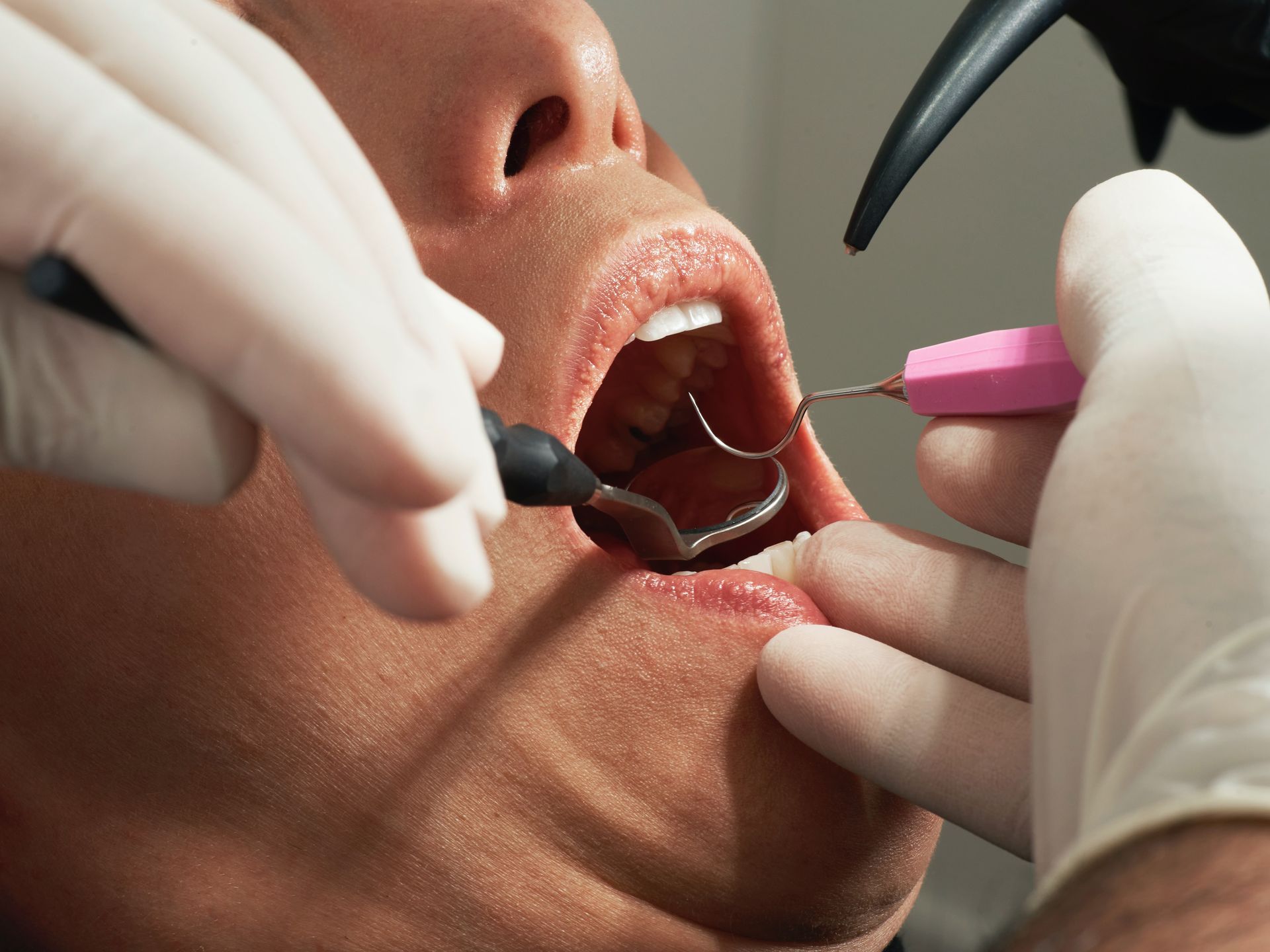 A person's mouth open during a dental examination. Dentist with tools in mouth.