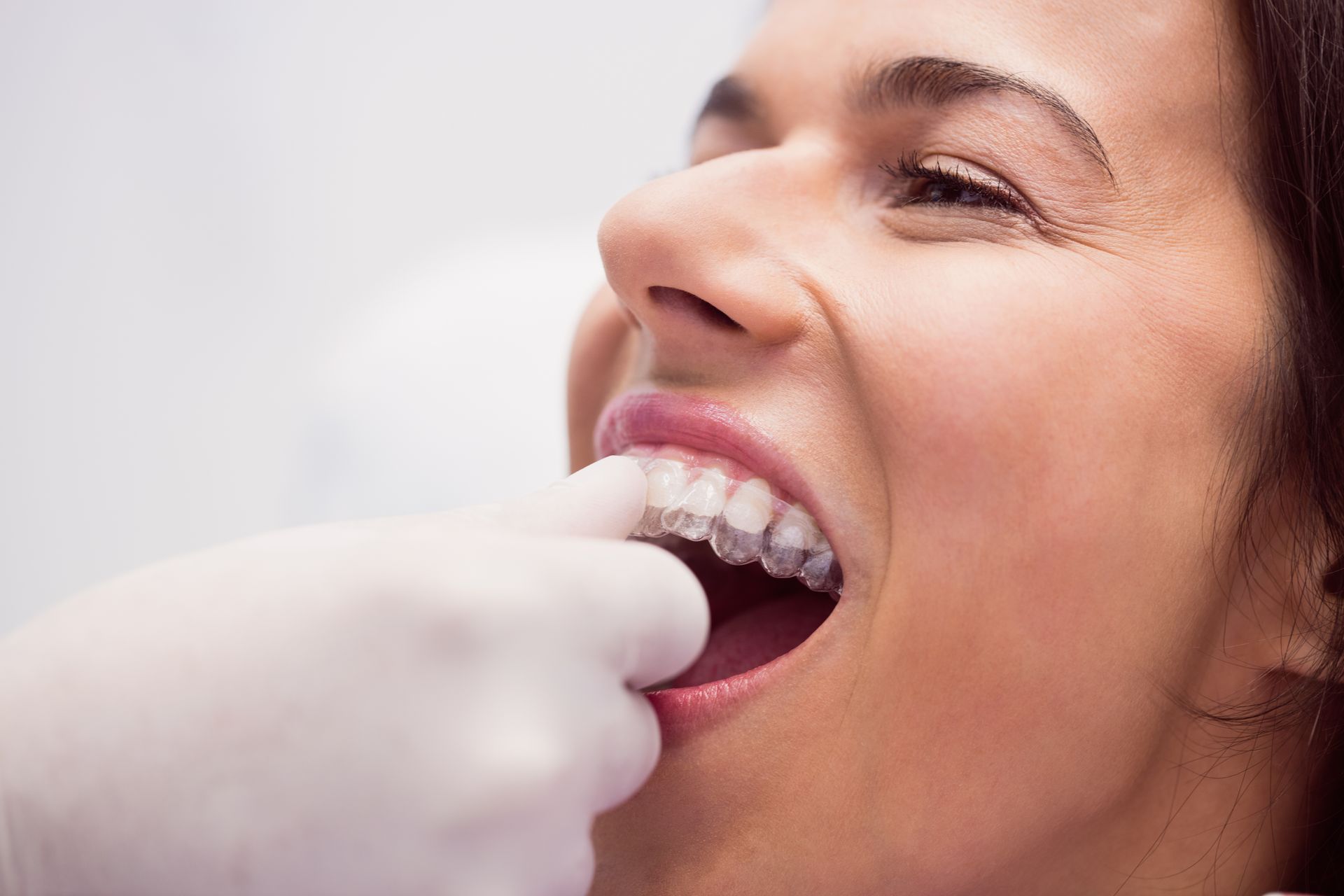 Person with clear aligners being fitted by gloved hand.