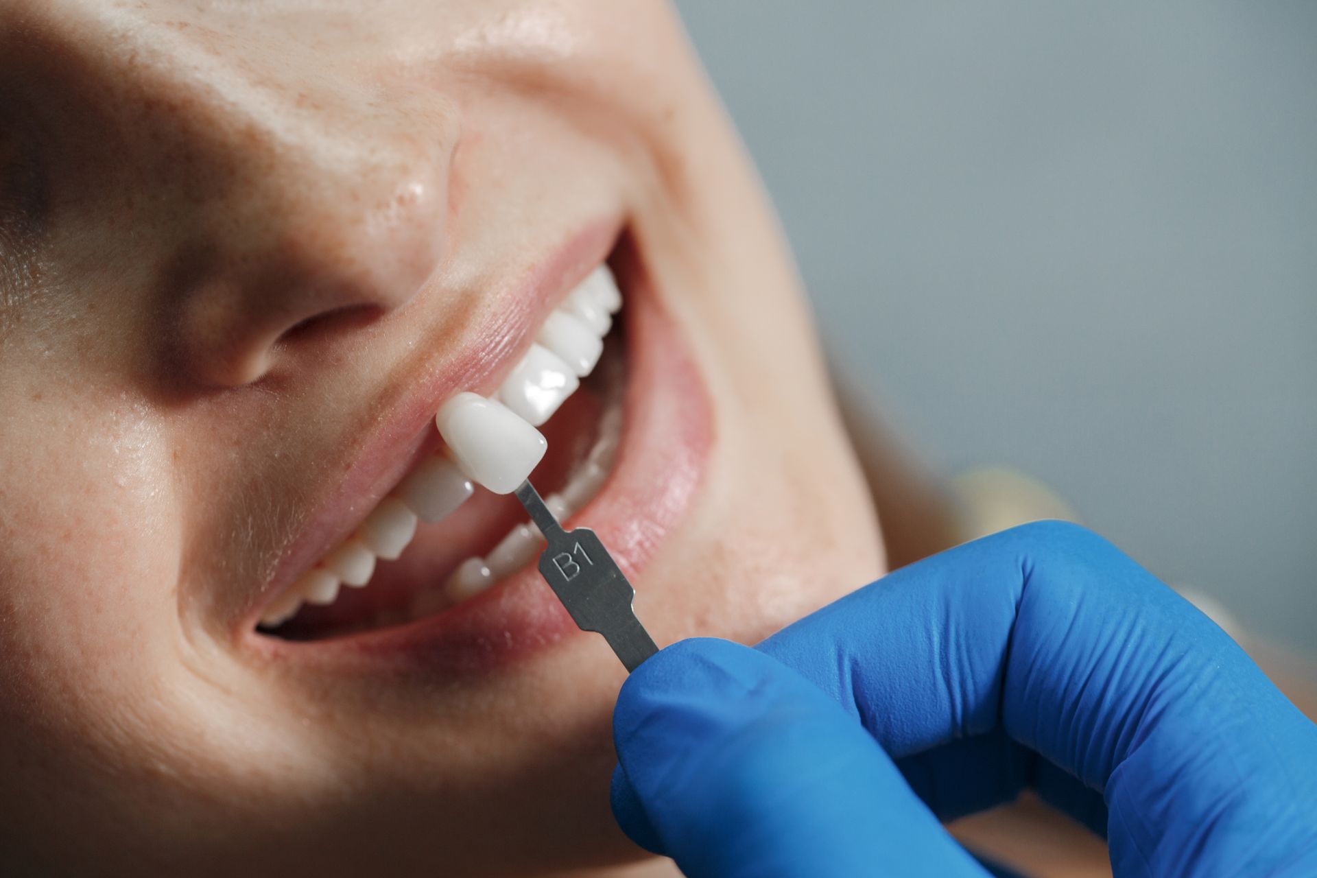 Tooth Bonding