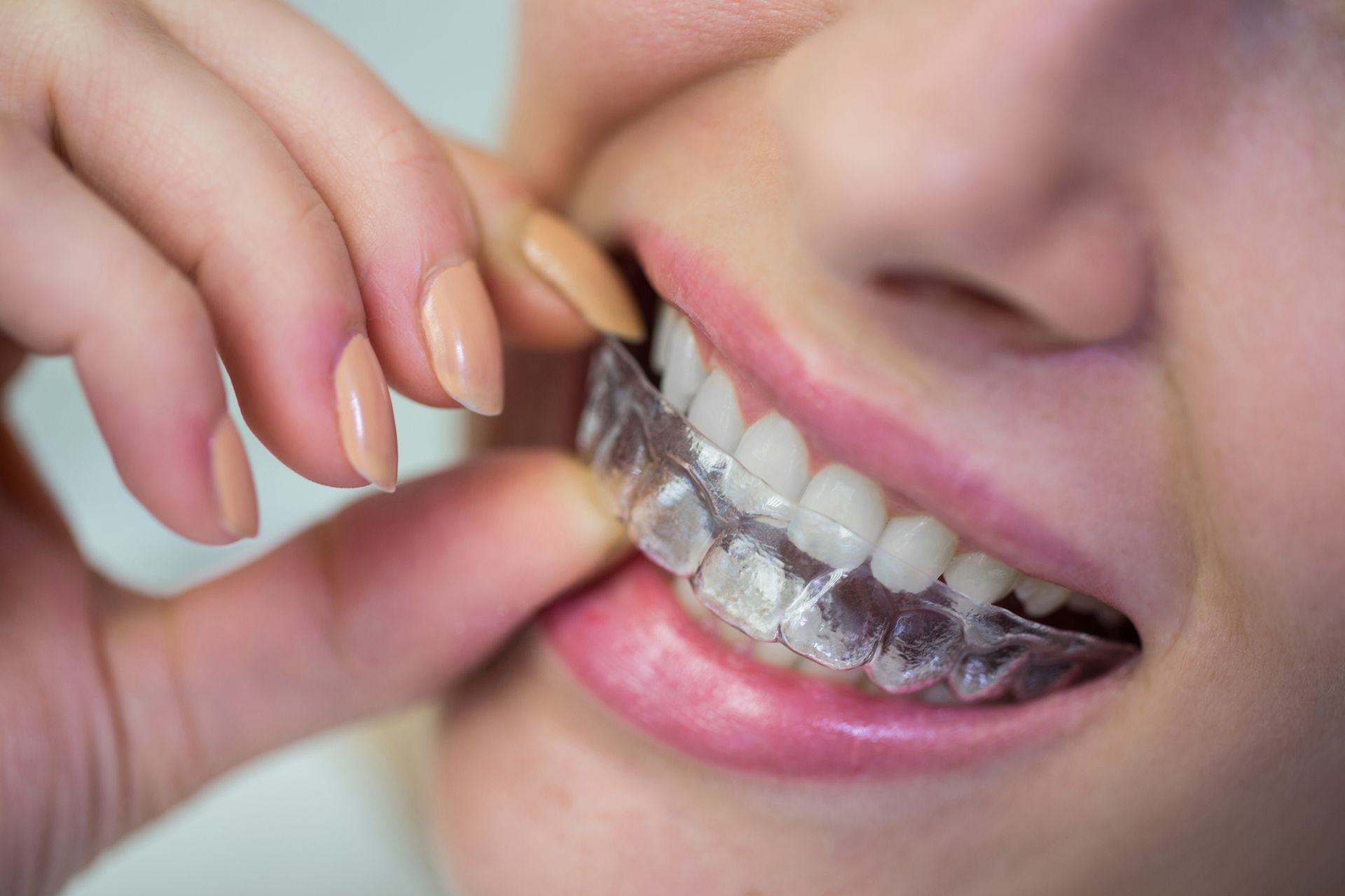 Person inserting clear aligner into mouth.