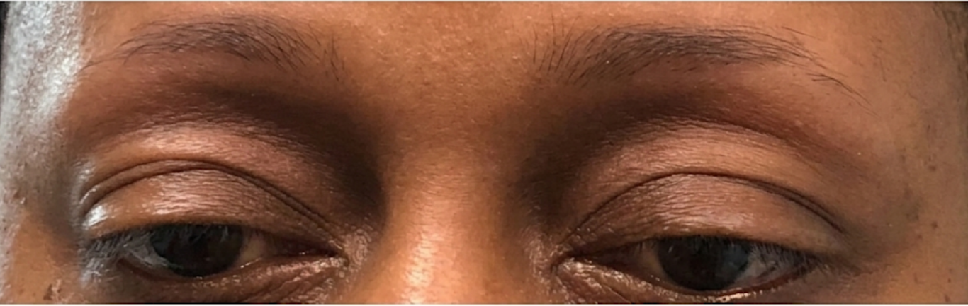 Close-up of a person's eyes and brow with slightly drooping eyelids.