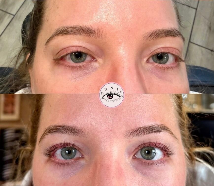 Before-and-after close-up of eyes showing eyelid discoloration improved after treatment.