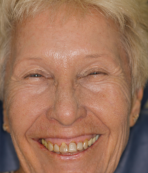 Patient 1 smile before treatment, Always About Smiles