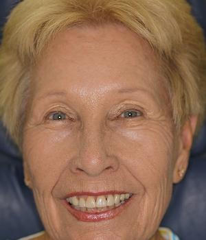Patient 1 smile after treatment, Always About Smiles