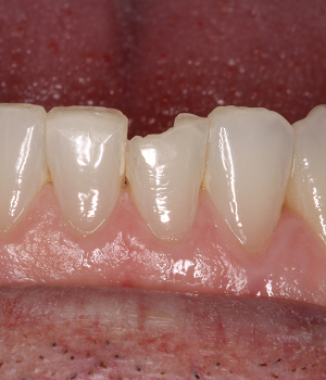 Patient 4 smile before treatment, Always About Smiles