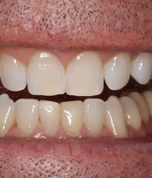 Patient 4 smile after treatment, Always About Smiles