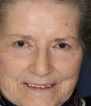 Patient 9 smile before treatment, Always About Smiles