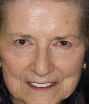 Patient 9 smile after treatment, Always About Smiles