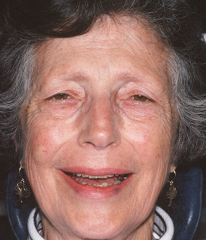 Patient 10 smile before treatment, Always About Smiles