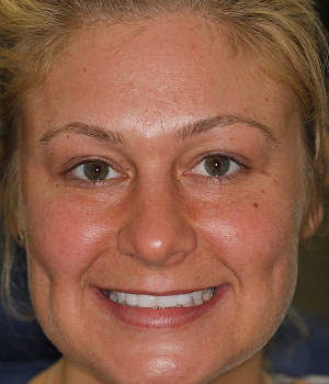 Patient 11 smile before treatment, Always About Smiles