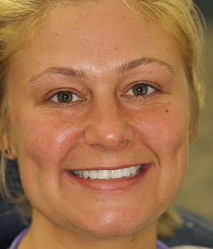 Patient 11 smile after treatment, Always About Smiles