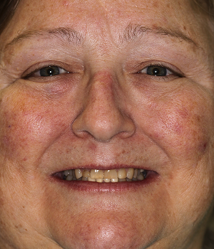 Patient 13 smile before treatment, Always About Smiles